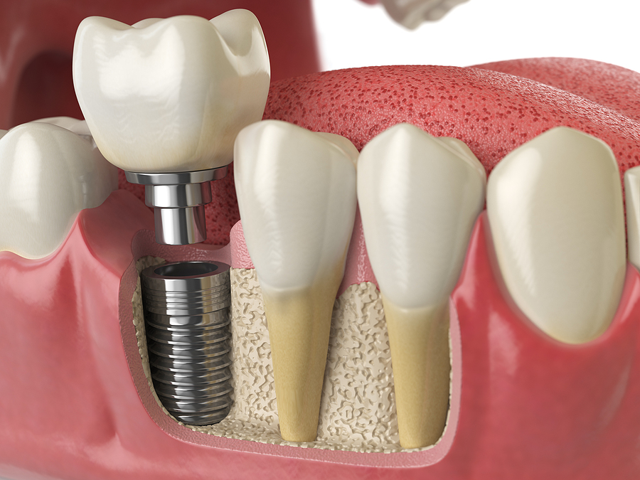 Everything You Need to Know About Dental Implants: A Complete Guide